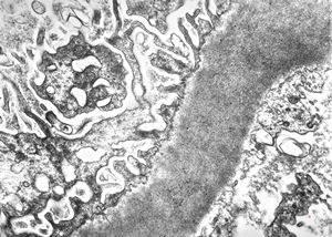 M,22y. | type II membranoproliferative glomerulonephritis